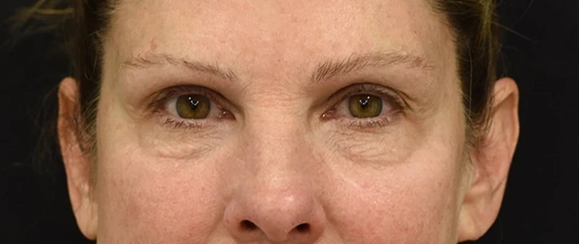 Eyelid Surgery Patient 16 Set 1 Before